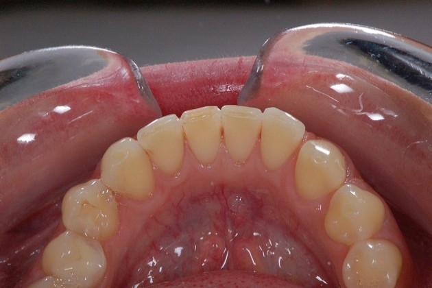 Ząb po odbudowie wypełnieniem kompozytowym