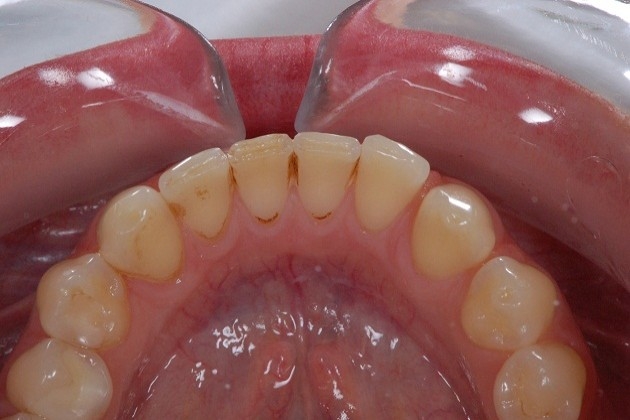 Ząb z ubytkiem próchnicowym przed wypełnieniem